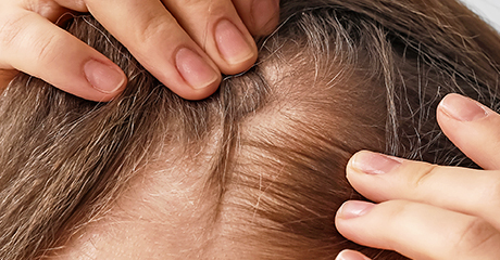 Hair loss