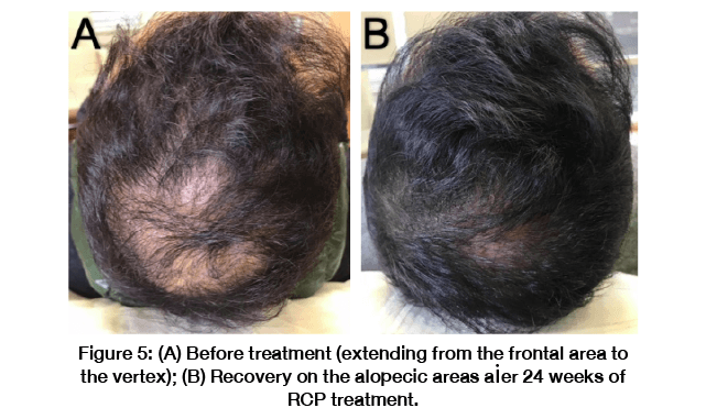 Research-backed Formulations
for `Hair Regrowth`