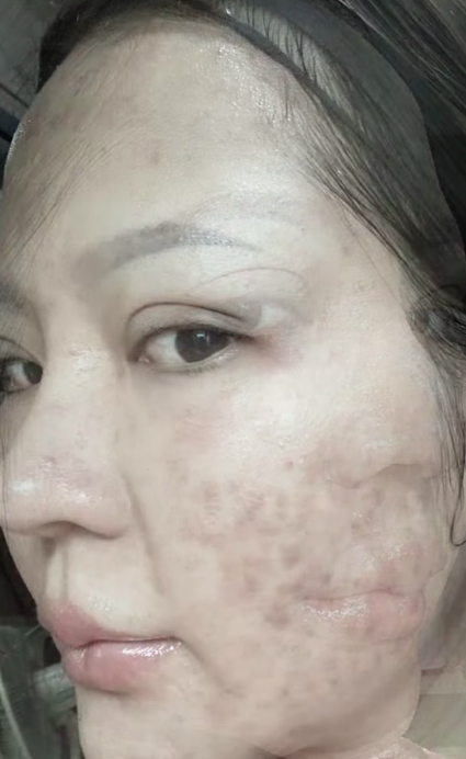 Recommended by those who have struggled with acne.
Special thanks to Keenloval for sharing the review 🙏